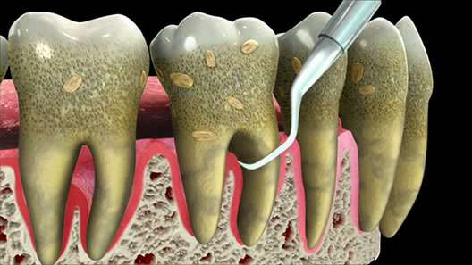 periodontal disease san fernando valley ca