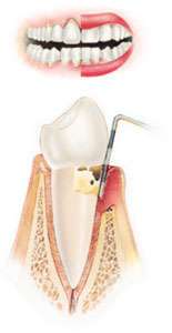 Stage 2 periodontal disease